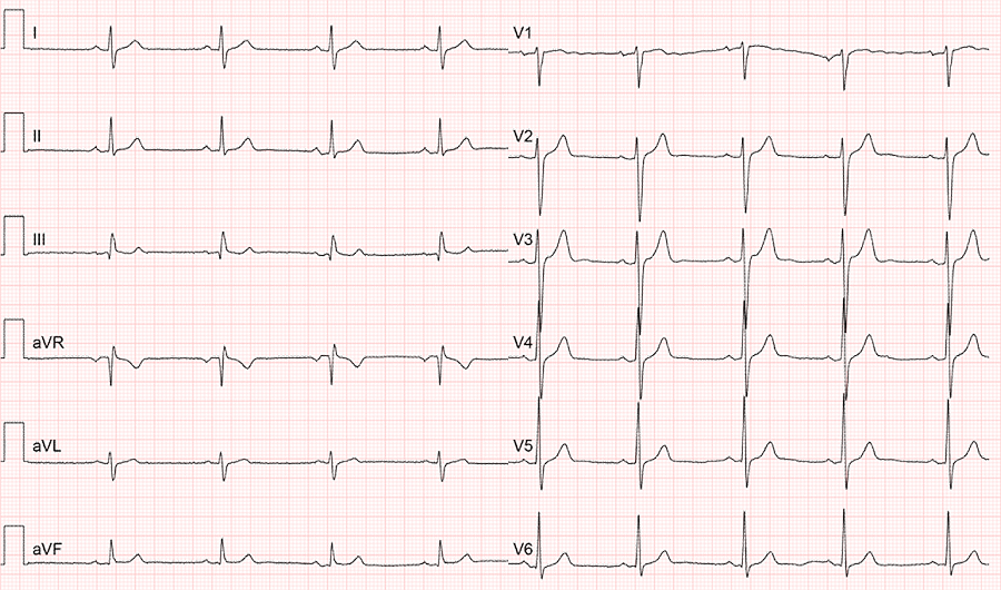 Standard-EKG vs. EKG-Uhren: Erklärung und Vergleich